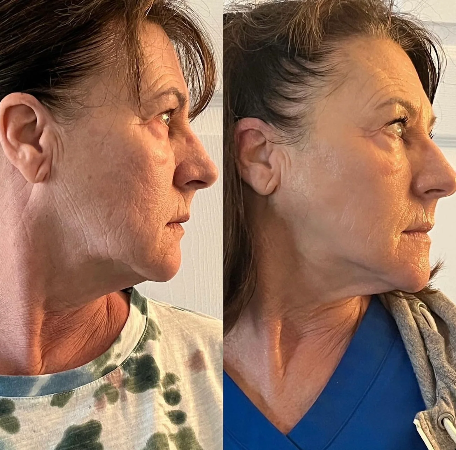 Cryo Facial before and after showing a firmer-looking jawline