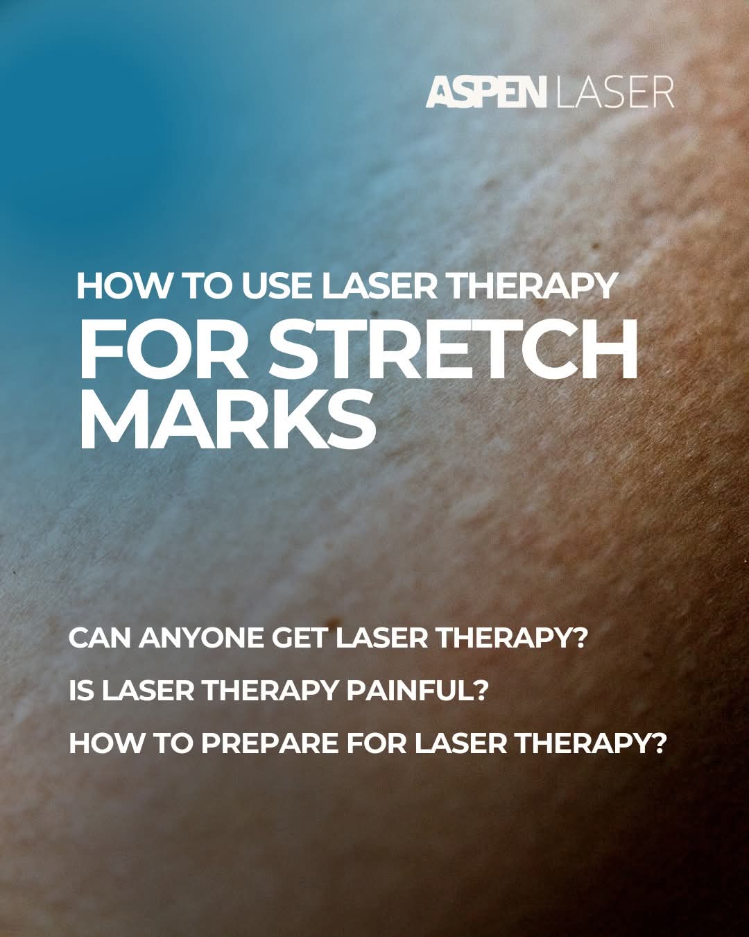 How to use laser therapy for stretch marks and common questions about laser therapy