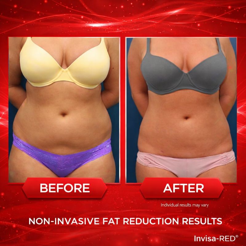 InvisaRed before and after results showing abdominal fat reduction at Cryogenix Palm Harbor
