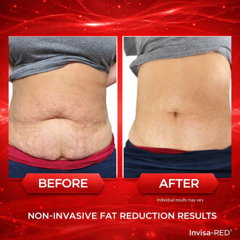 InvisaRed before and after showing skin tightening and stretch mark improvement results