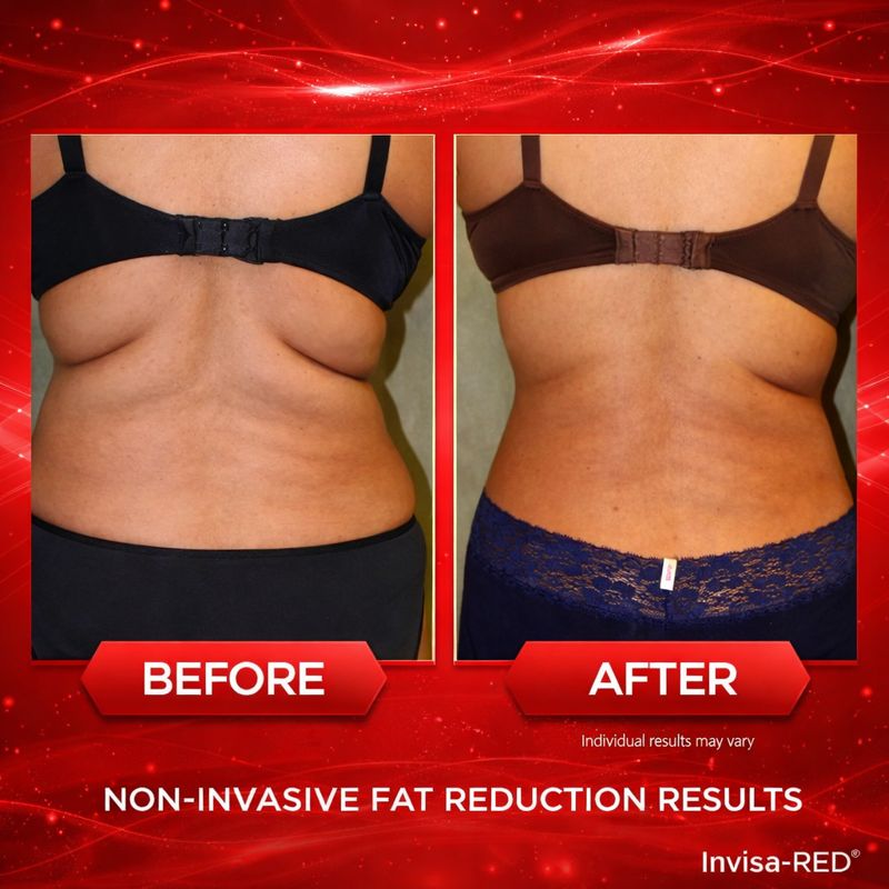 InvisaRed before and after transformation showing waist contouring and back fat reduction
