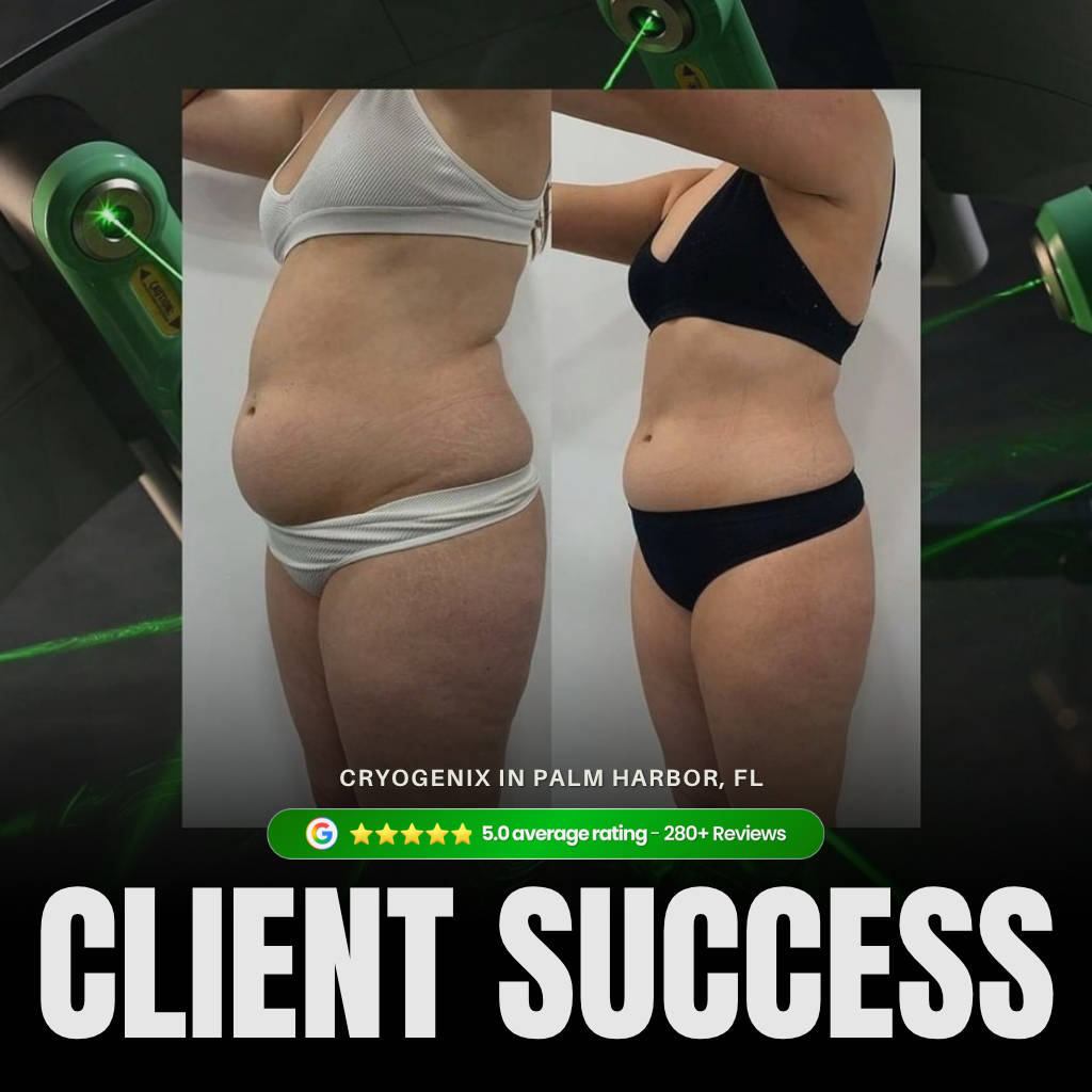 Laser-Lipo before and after results showing side profile body transformation at Cryogenix Palm Harbor