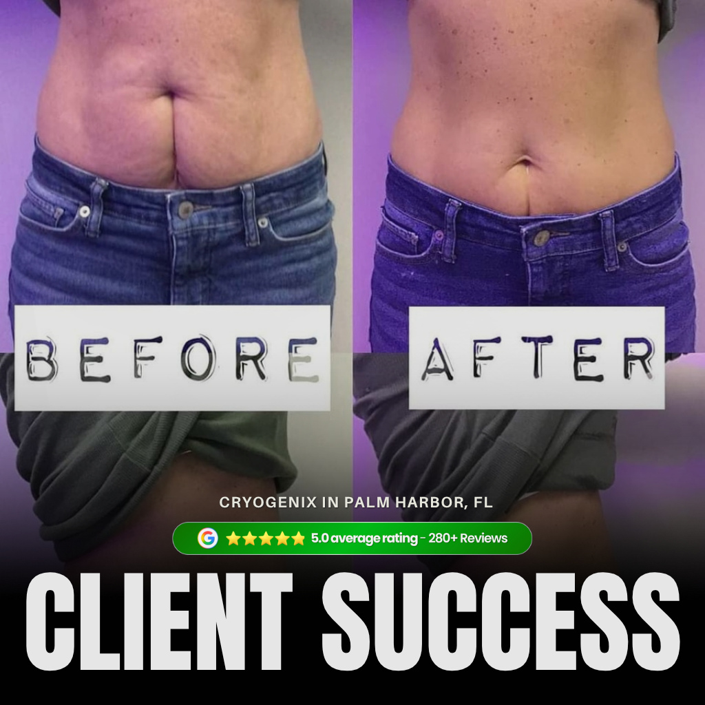 Laser-Lipo before and after transformation showing stomach contouring results