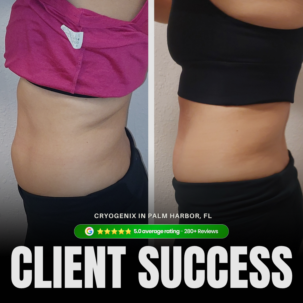 Laser-Lipo client before and after results showing waist and hip fat reduction