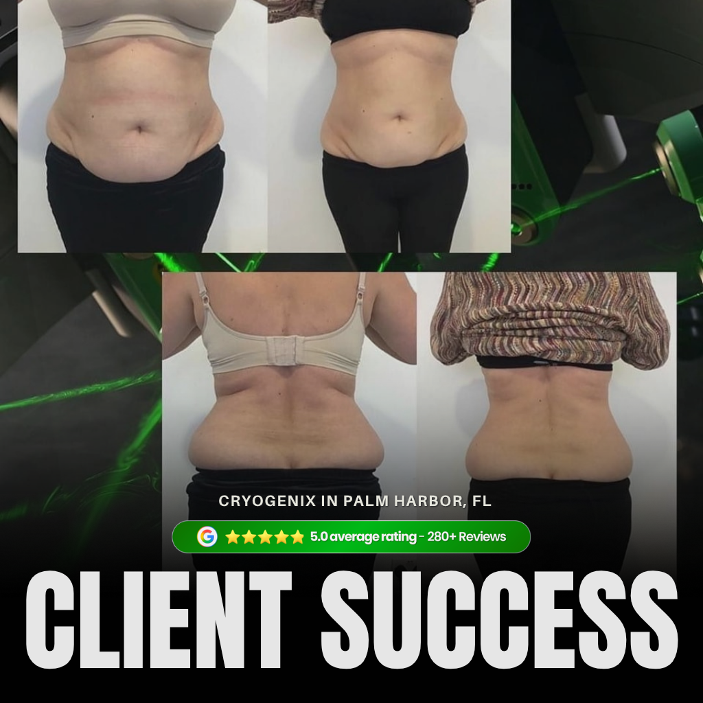 Laser-Lipo comprehensive before and after showing front and back body transformation